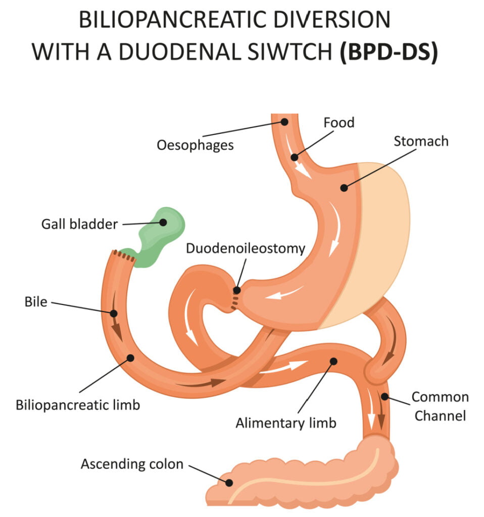 Duodenal switch procedure inforgraphic